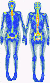 Knochenszintigrphie: Darstellung eines gesunden Skelett